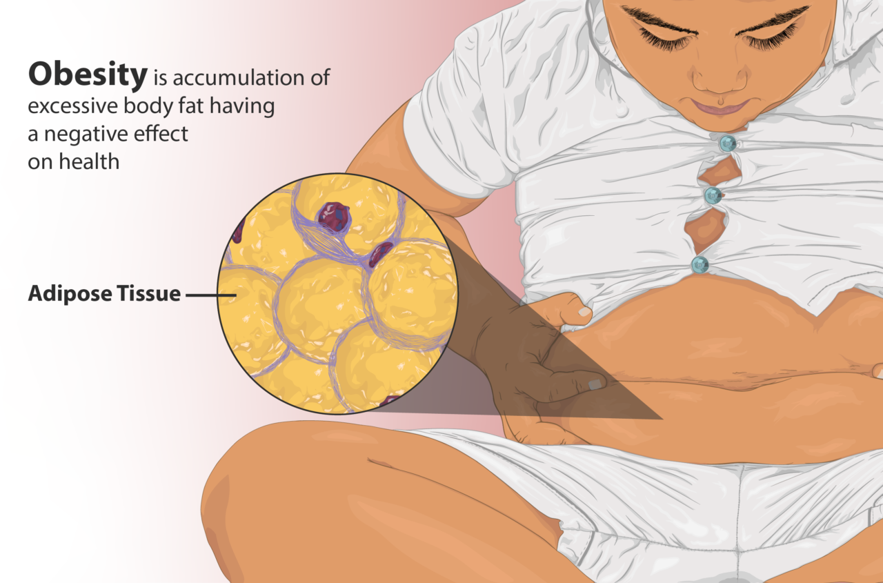 Depiction of a child with significant abdominal fat